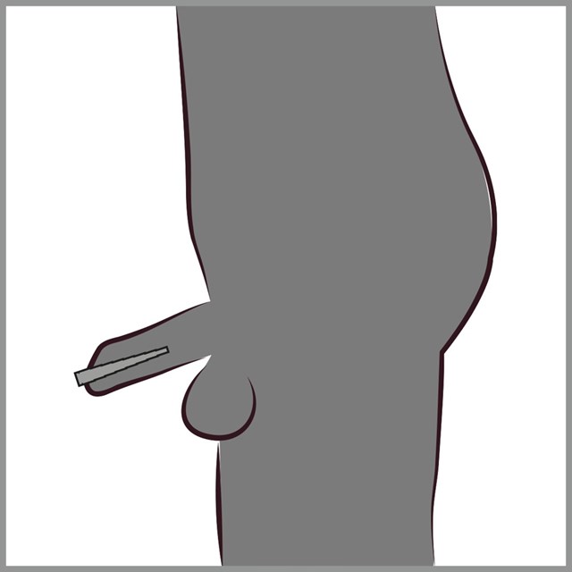 Stepped Dilator 9 cm